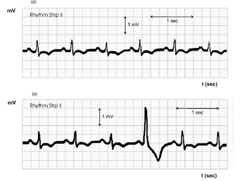 图2:人类心脏的心电图图