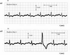 图2:心脏EKG图